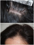 Why Choose The Foundation for Hair Restoration | Miami, FL