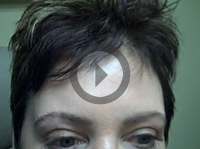 Mindy, 6 Months Post Op Eyebrow Transplant