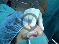 Dr. Jeffrey S. Epstein - Female Eyebrow Transplant Surgery