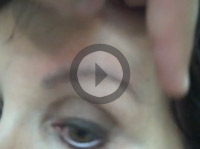 Female Patient - Post Op of 660 Graft Eyebrow Transplant