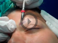 Explanation of Creating Natural Appearing Eyebrow Transplant