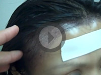 Female Asian Patient - More Oval Hairline - 1 Day 