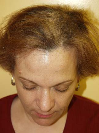 Reparative Hair Transplants - Before