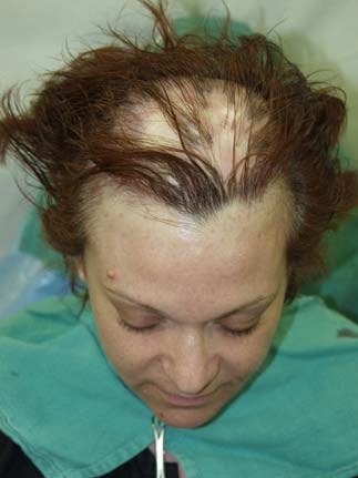 Reparative Hair Transplants - Before - Miami, FL
