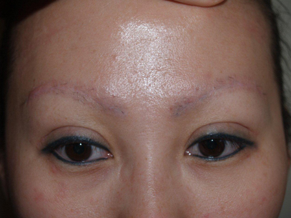 Restoring of Eyebrows and Eyelashes - Before