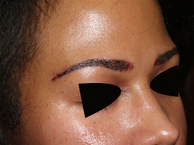 eyebrow transplant - patient 48 - after 2