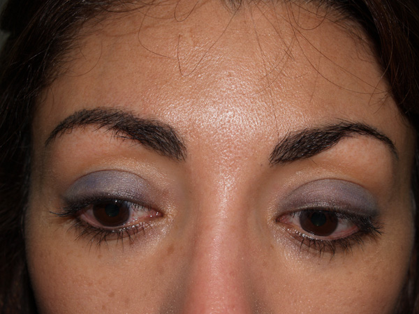 eyebrow transplant - patient 12 - before 1