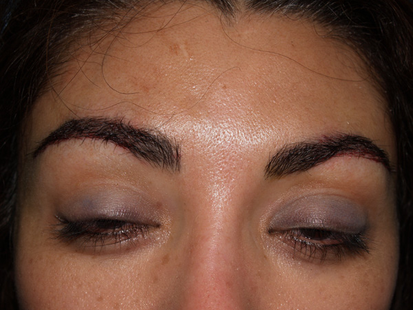 eyebrow transplant - patient 12 - after immediately 1