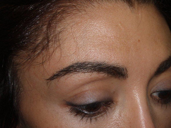 eyebrow transplant - patient 12 - after 2