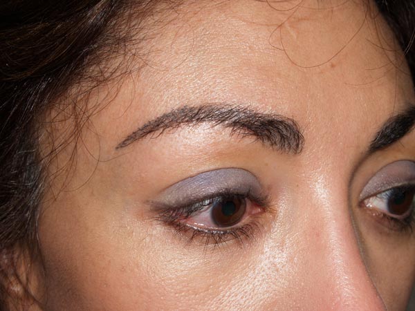 eyebrow transplant - patient 12 - before 2