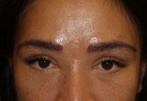 eyebrow and eyelashes - patient 118 - after immediately 1