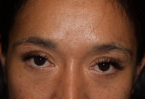 eyebrow and eyelashes - patient 118 - before 1