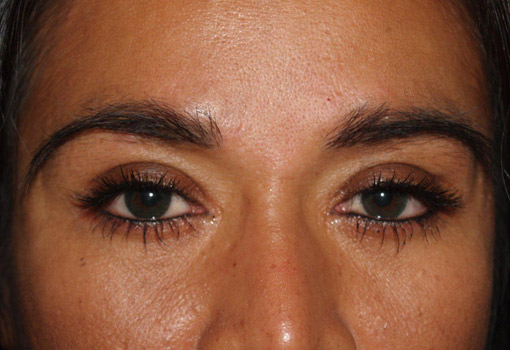 eyebrow and eyelashes - patient 118 - after 1