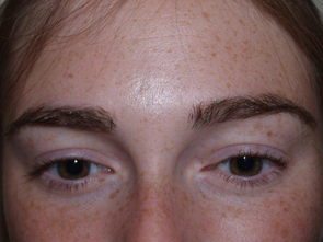 eyebrow and eyelashes - patient 124 - after 1