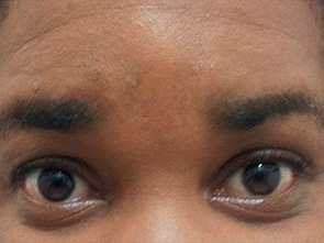 eyebrow and eyelashes - patient 121 - after 1