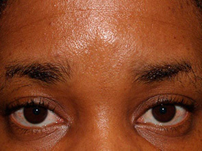 eyebrow and eyelashes - patient 121 - before 1