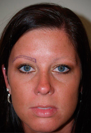 eyebrow transplant - patient 11 - before 1