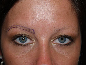eyebrow transplant - patient 11 - before 2