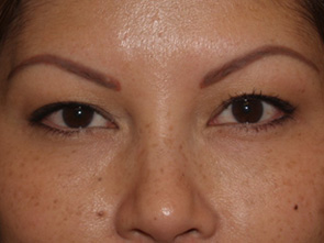 eyebrow and eyelashes - patient 122 - before 1