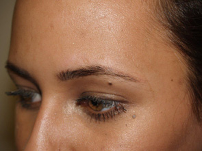 eyebrow transplant - patient 6 - before 2