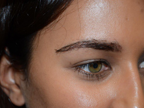 eyebrow transplant - patient 6 - after 3