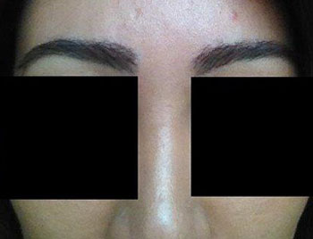 eyebrow transplant - patient 15 - after 1
