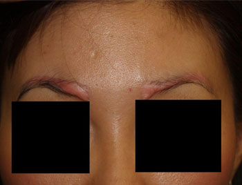 eyebrow transplant - patient 15 - before 1