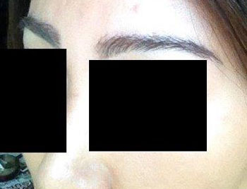 eyebrow transplant - patient 15 - after 2