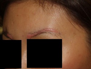 Miami, Fl. Eyebrow transplant Photo - Patient 1 - Before 2