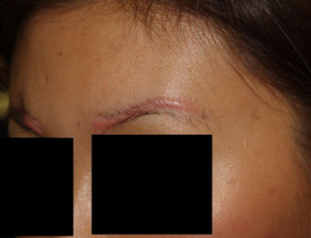 eyebrow transplant - patient 15 - before 2