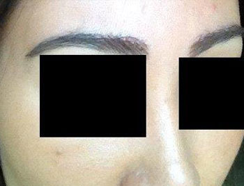 eyebrow transplant - patient 15 - after 3