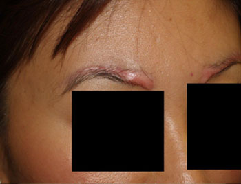 eyebrow transplant - patient 15 - before 3