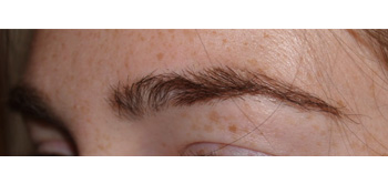 eyebrow transplant - patient 2 - after 2