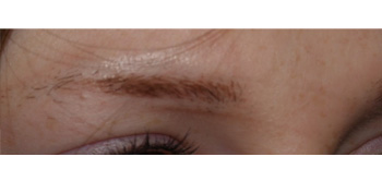 eyebrow transplant - patient 2 - before 3