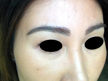 eyebrow transplant - patient 25 - after 3