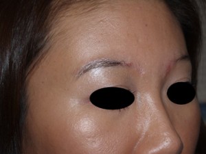 Miami, Fl. Eyebrow transplant Photo - Patient 1 - After 1