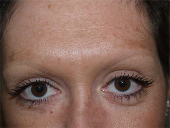 eyebrow and eyelashes - patient 114 - before 2
