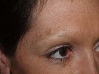 eyebrow and eyelashes - patient 114 - before 3