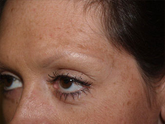 eyebrow and eyelashes - patient 114 - before 4