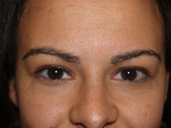 eyebrow transplant - patient 8 - after 1