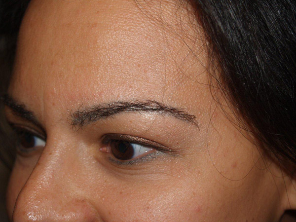 eyebrow transplant - patient 8 - after 2