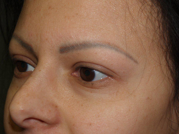 eyebrow transplant - patient 8 - before 2
