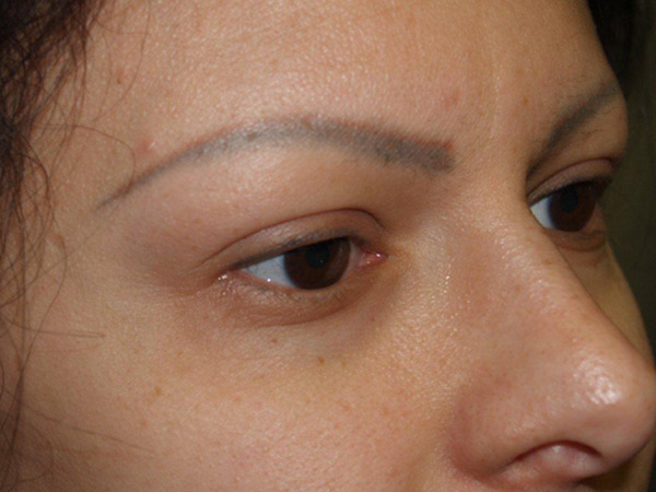 eyebrow transplant - patient 8 - before 3