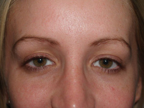 eyebrow transplant - patient 29 - before 1