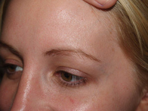 eyebrow transplant - patient 29 - before 2