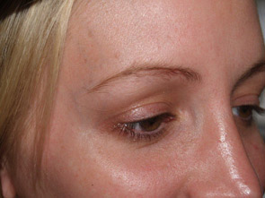 eyebrow transplant - patient 29 - before 3