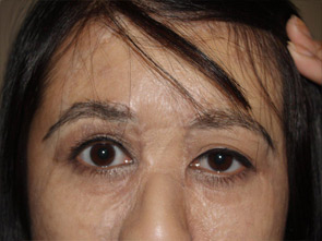 eyebrow transplant - patient 21 - after 1