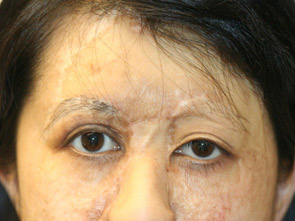 eyebrow transplant - patient 21 - before 1