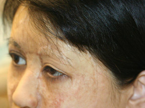 eyebrow transplant - patient 21 - before 2