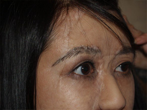 eyebrow transplant - patient 21 - after 3